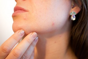 Tratamientos para el cuidado del acné